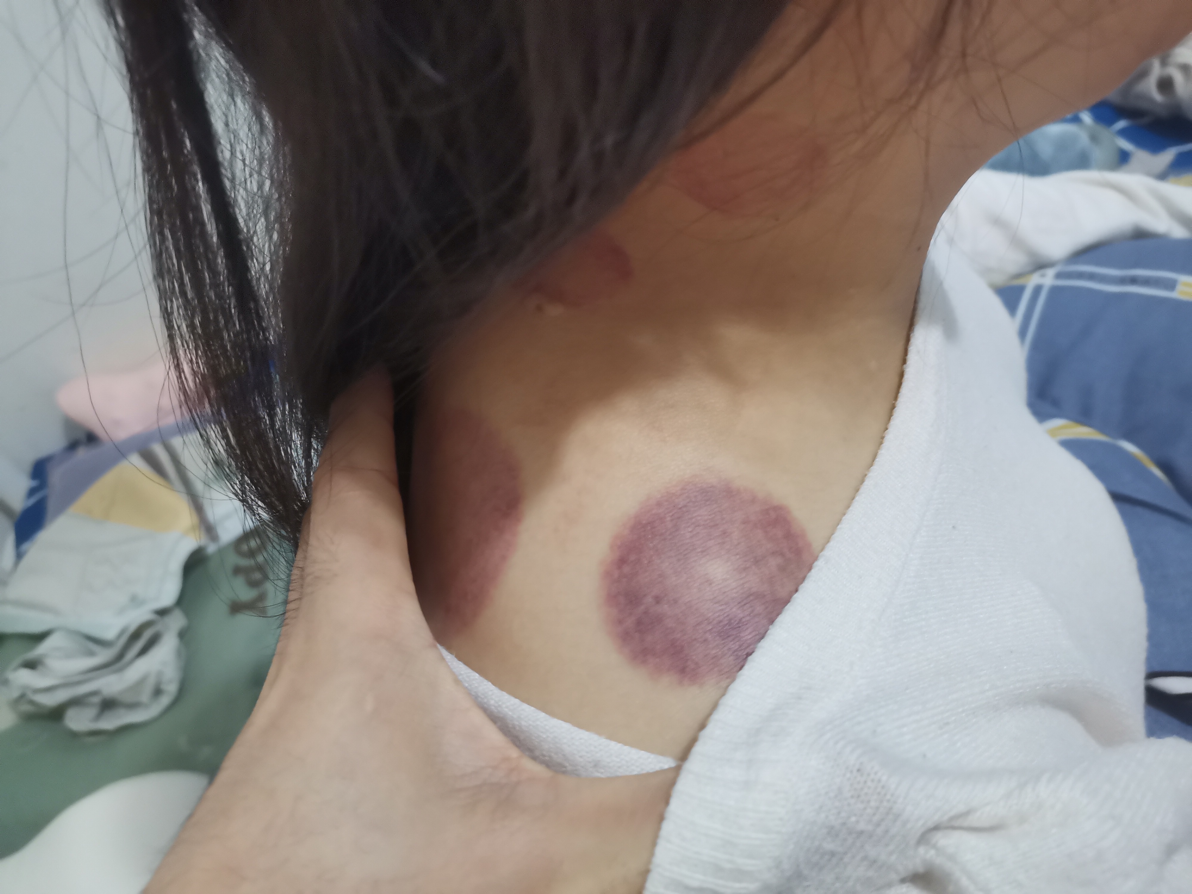 20231120 · 宝宝颈椎痛 · 拔罐